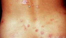 梅毒 吃瓜,吃瓜群众如何看这场健康危机