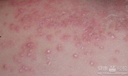 湿疹可以吃小瓜吗,湿疹患者适宜食用小瓜的探讨