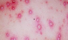 梅毒 吃瓜,吃瓜群众如何看这场健康危机